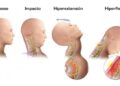 Latigazo Cervical | Es una lesión que ocurre por la aceleración y ...