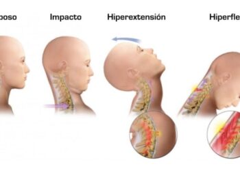 Latigazo Cervical | Es una lesión que ocurre por la aceleración y ...