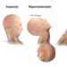 Latigazo Cervical | Es una lesión que ocurre por la aceleración y ...