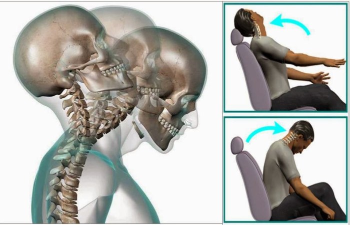 Rectificacion De La Lordosis Fisiologica Cervical Que Es Esop ...
